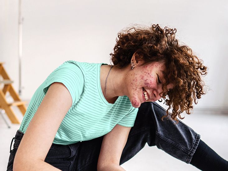 Hidradenitis Suppurativa vs. Other Skin Conditions Hidradenitis Suppurativa vs. Other Skin Conditions